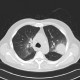 Angioinvasive aspergilosis: CT - Computed tomography